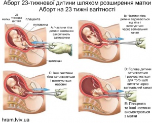 Аборти